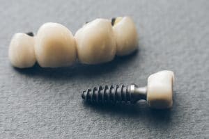 bridges and dental implants