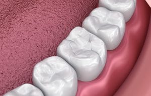 composite resin dental filling