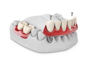 dental implants