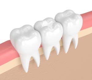 3d render of teeth with dental composite filling in gums