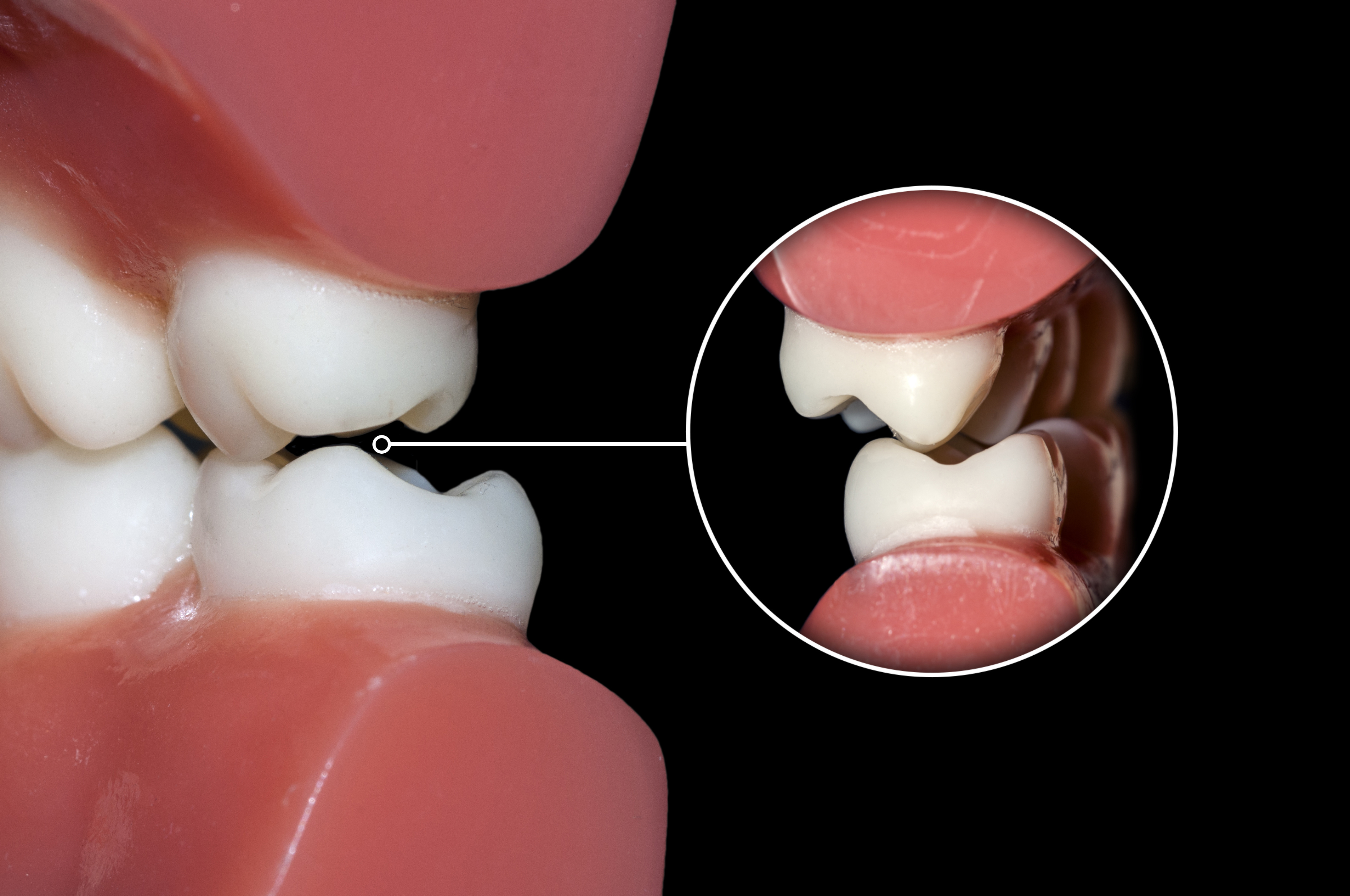 DENTAL FILLINGS improve the function of the jaw for biting and chewing