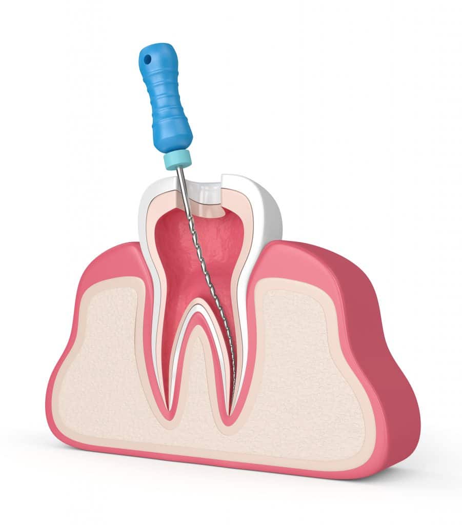 3d render of tooth with endodontic file  in gums over white background. Root canal treatment concept.