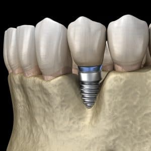 Periimplantitis with visible bone reduction. Medically accurate 3D illustration of dental implants concept