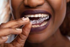 What Would Clear Aligners Do For Your Smile?