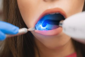 Reversing Tooth Decay Quickly
