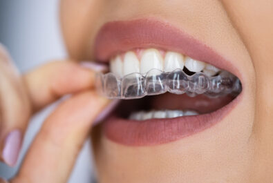 closeup of clear aligners on smile
