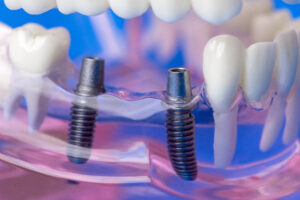 omaha implant bridge