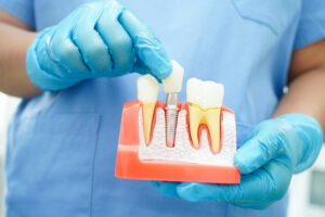 omaha dental implants