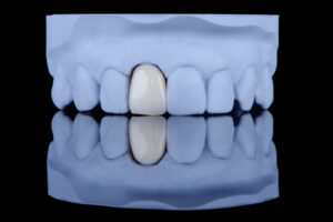 omaha porcelain veneers