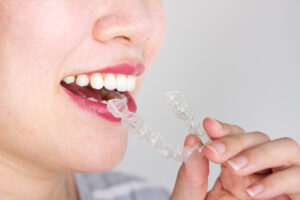 omaha clear aligners