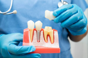 omaha cerec crowns 